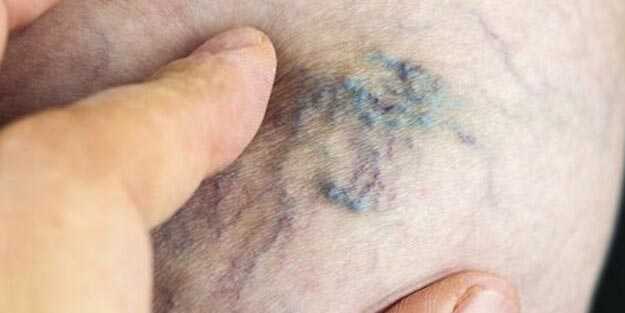 Varis lazer tedavisi nasıl yapılır?