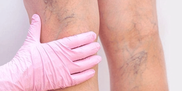 Varis oluşumuna nasıl engel oluruz? İşte en net cevabı