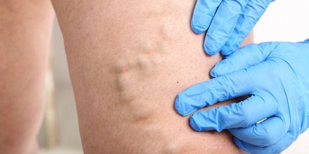 Varis oluşumunu önlemek için 5 yöntem