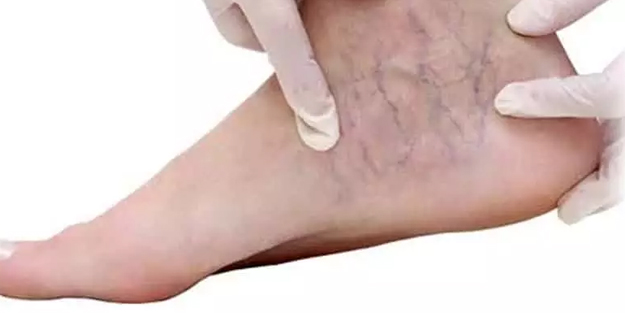 Varise incir yaprağı çözümü