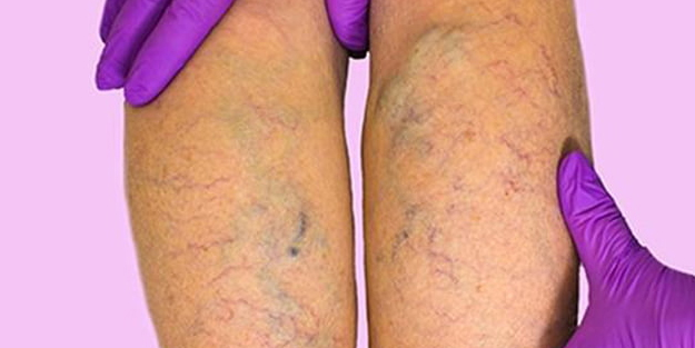  Varisli damarlardan sonsuza dek kurtaran karışım: Öyle bir şey ki bakın sanki baştan ayağa yeniliyor!