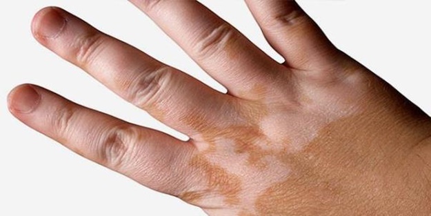 Vitiligo hastalığına dikkat!