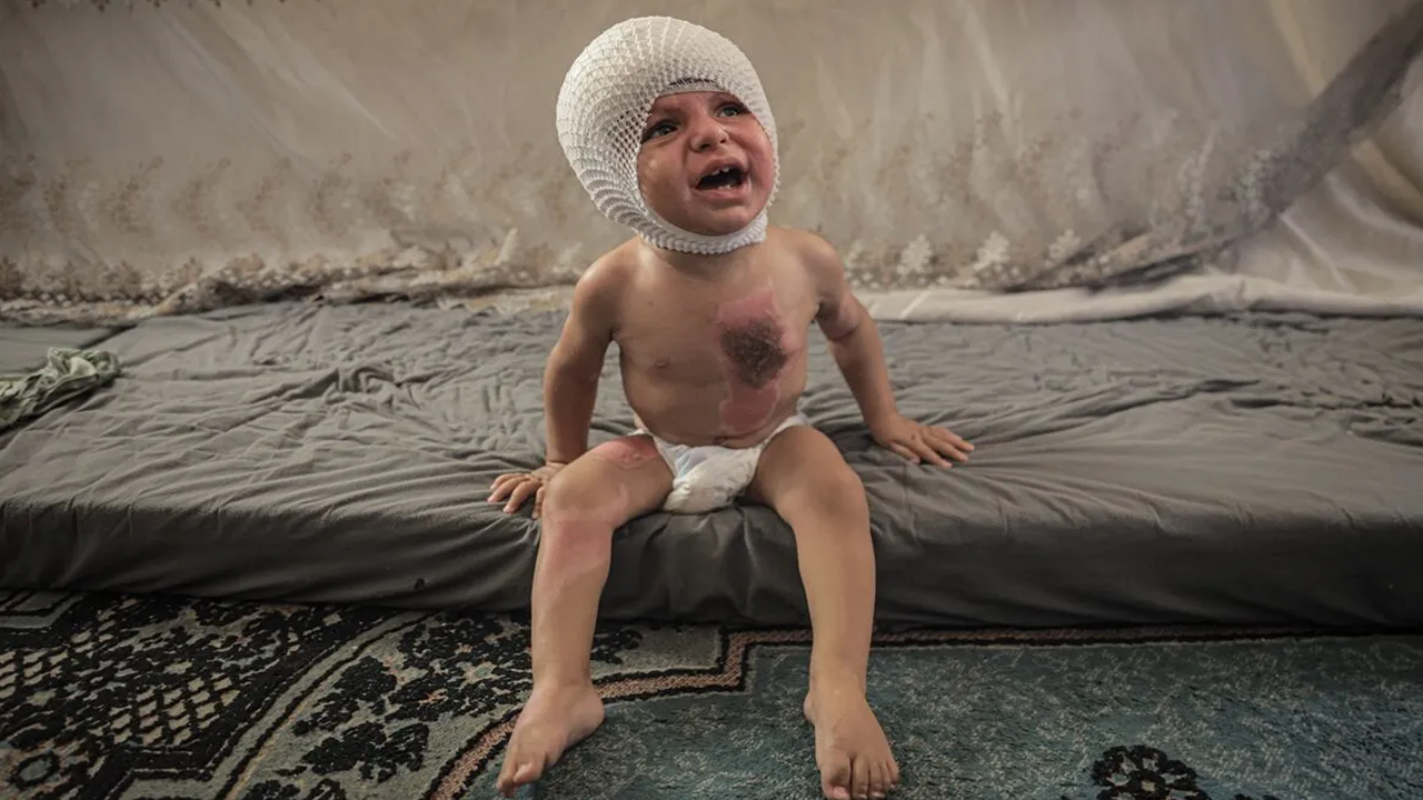 Vücudu yanan Muhammed yardım bekliyor!