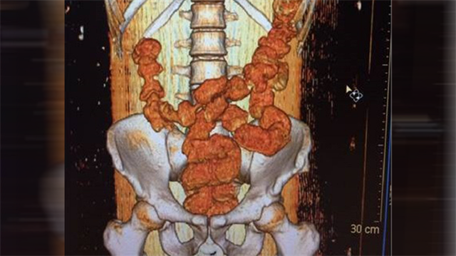 Vücudundan 18 kapsül kokain çıktı