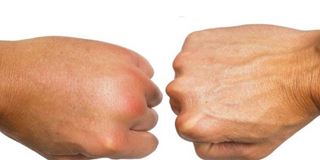 Vücudunuzdaki ödeme dikkat