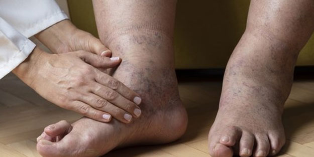 Vücuttaki ödeme savaş açan gıdalar