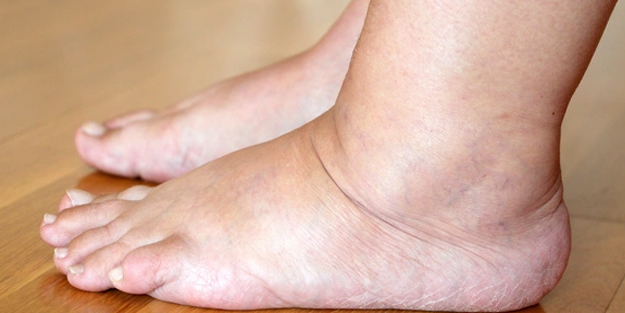 Vücuttaki ödemi atmak için bu besinler önemli!