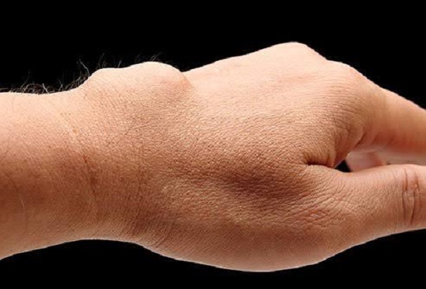 Yağ bezeleri kanser türü müdür?