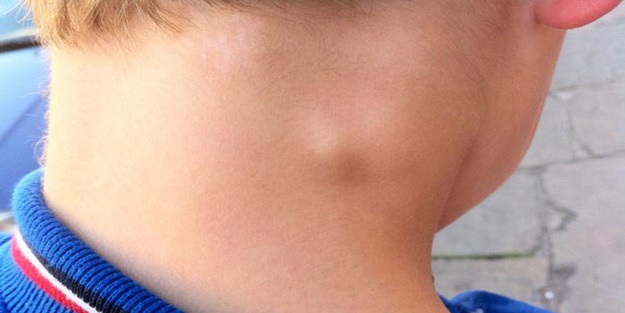 Yağ bezesi nedir ve yağ bezesi neden oluşur?