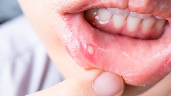 Yalnızca bebeklerde görülmüyor! İşte, pamukçuğa sebep olan o hata