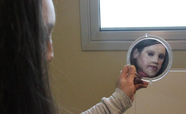 Yanan yüze yeni doku geliştirildi