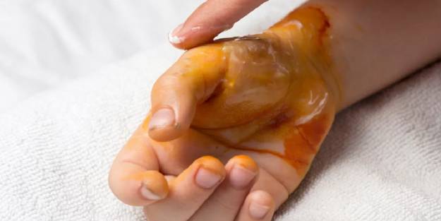 Yanığa ne iyi gelir?