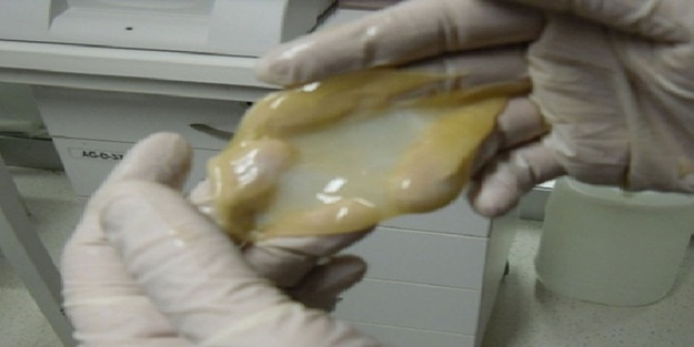 Yanık hastalarına umut... Kan ve kök hücreden yapay deri üretildi