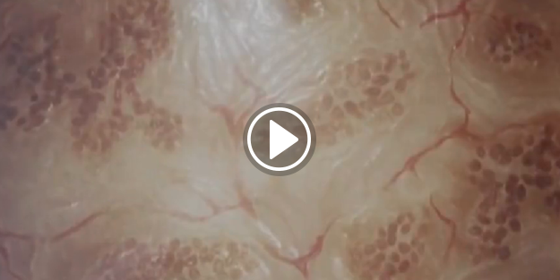 Yanık-yara tedavisinde devrim!