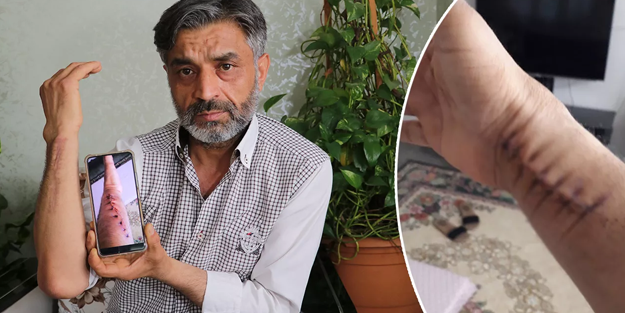 Yanlış ameliyat hayatını kabusa çevirdi: Elindeki şişlik için gitti, başına gelmeyen kalmadı!