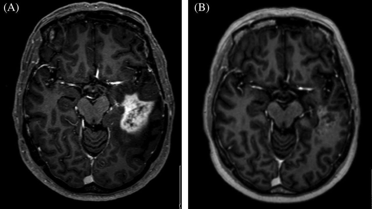 Yapay zeka beyin tümörü teşhisinde radyologları yendi