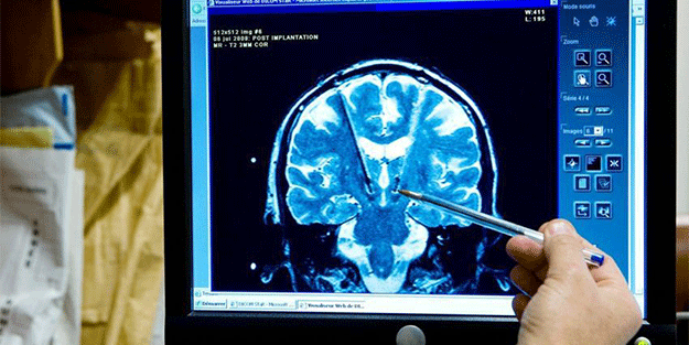 Yapay zeka felçli hastaya çare oldu! 20 yıl sonra yeniden konuşma yeteneği kazandı