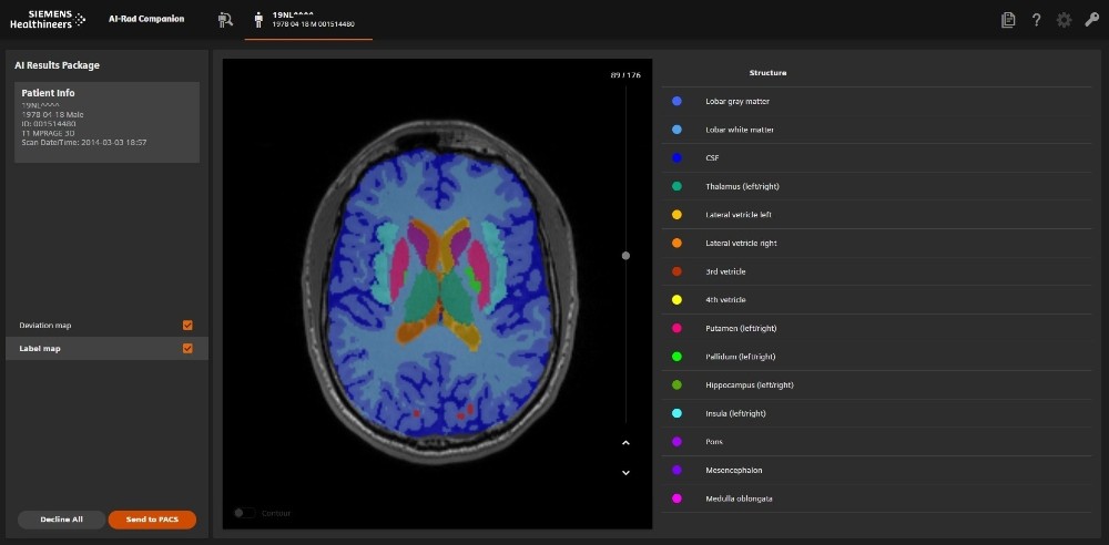 Yapay zeka MR ile birleşti teşhiste umut oldu 