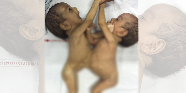 Yapışık bebekler ayrıldı