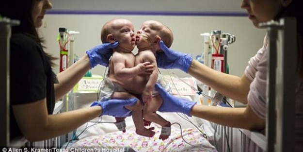 Yapışık ikizler 7 saat süren ameliyatla ayrıldılar