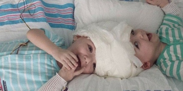 Yapışık ikizler ameliyatla ayrıldı!