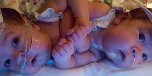 Yapışık ikizlerden iyi haber