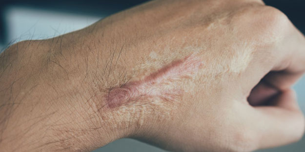 Yara izlerine karşı doğal çözümler