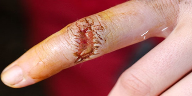 Yaralar hakkında doğru bilinen yanlışlar