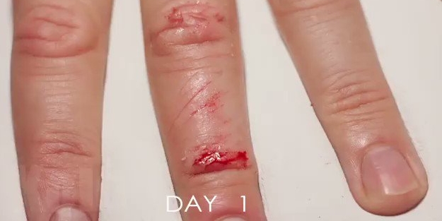 Yaralı parmağın 33 günde iyileşme videosu büyüledi