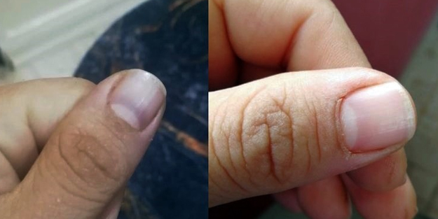 Yaşadığı hastalığın adı bile yok! Elleri, ayakları morarmaya başladı