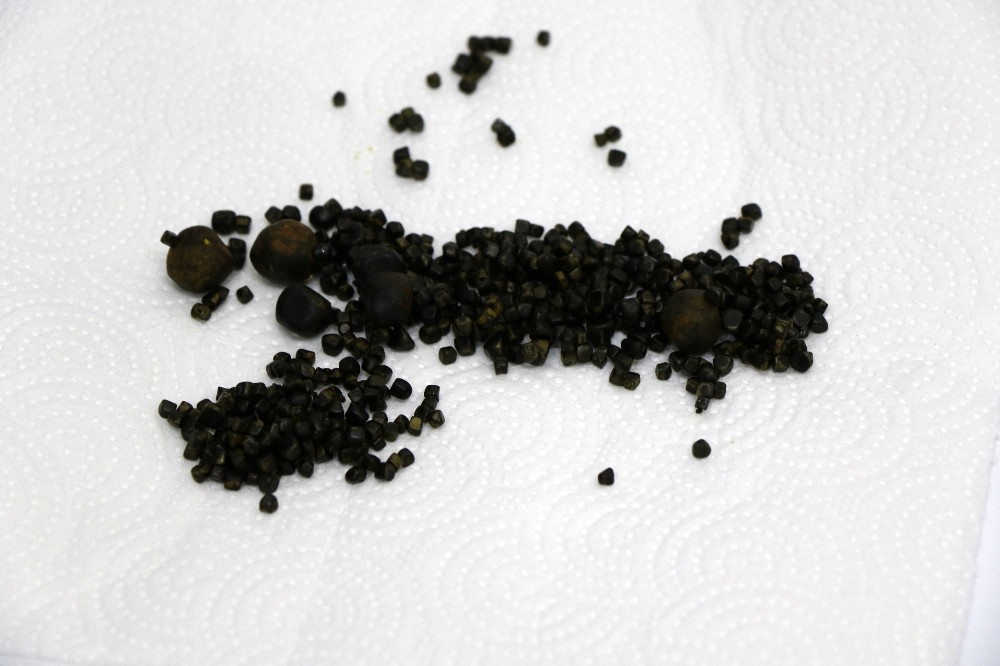 Yaşlı kadının safra kesesinden 450 tane taş çıktı 