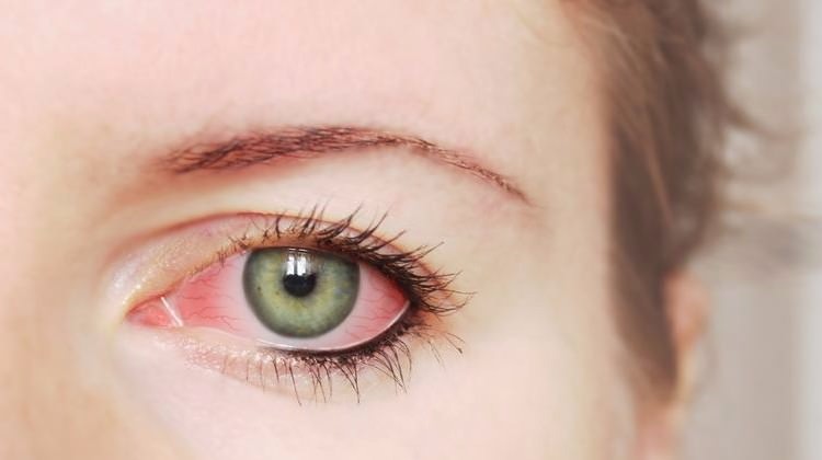 Yaz ayında göz enfeksiyon sorununa dikkat