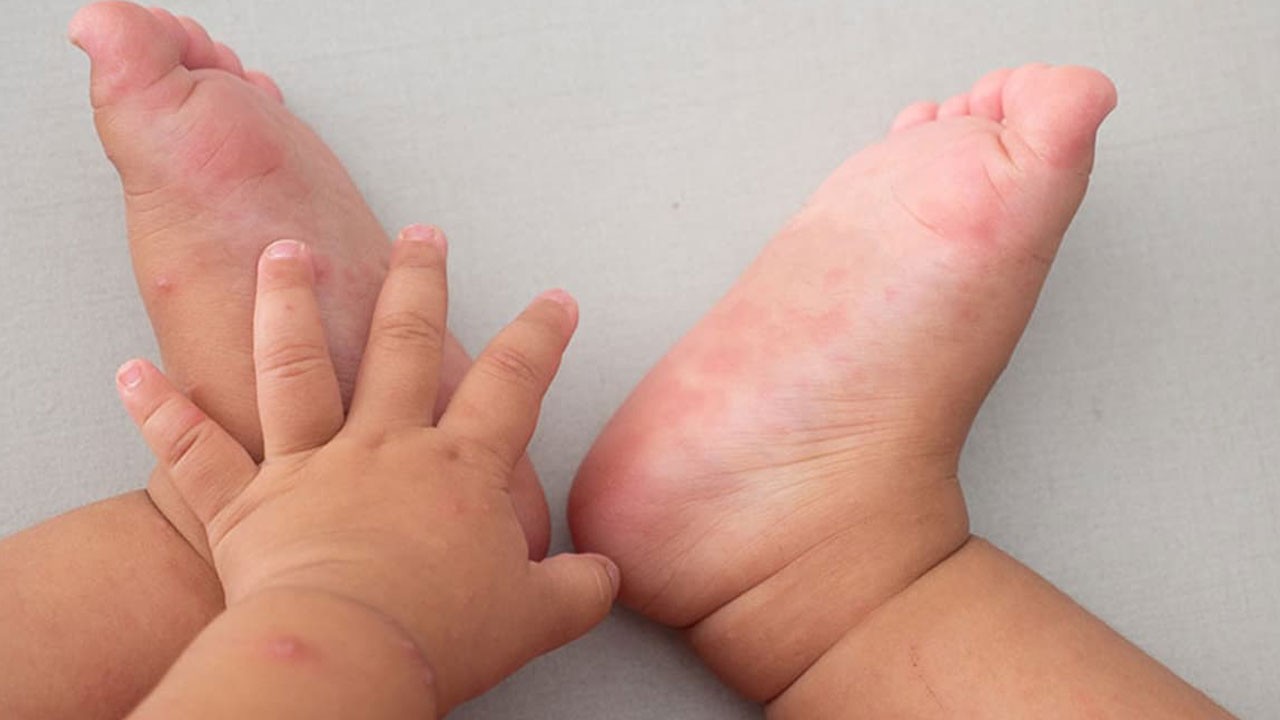 Yaz aylarında çok dikkatli olun! Bu virüs hızla yayılıyor