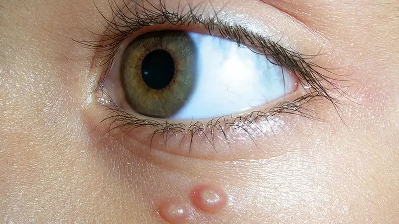 Yaz aylarında sessizce yayılıyor! Çocuklarda görülen bu cilt kabarcıklarına dikkat