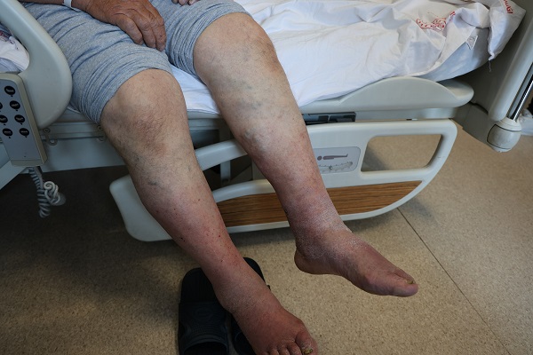 Yaz aylarında şikayet artıyor! İşte sebebi