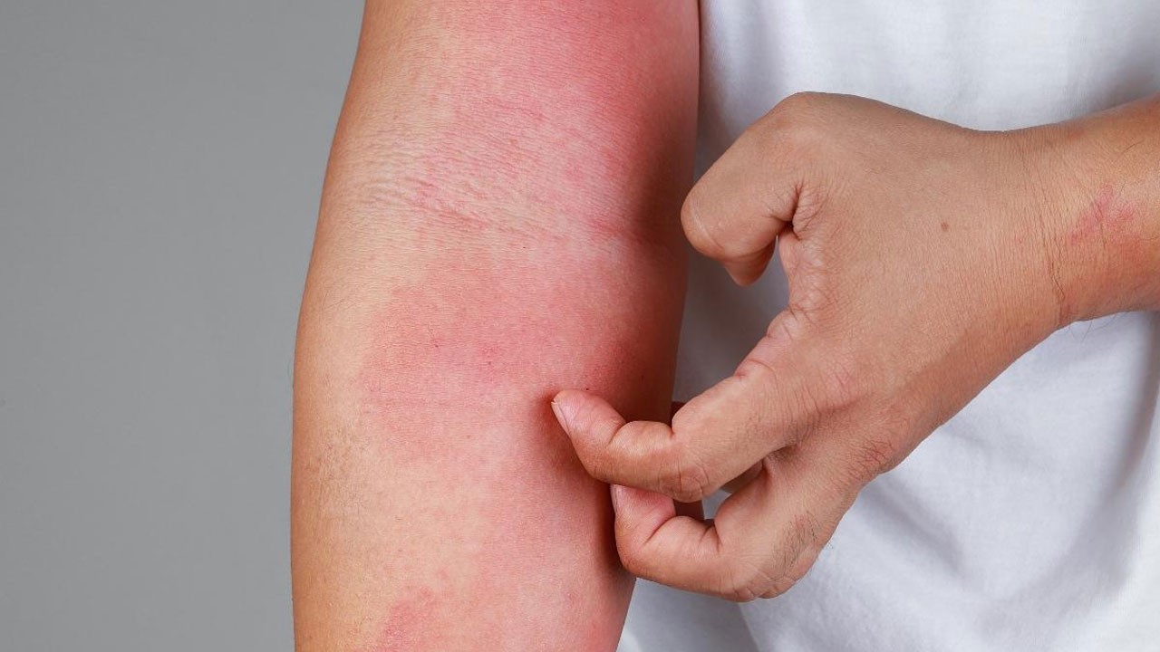 Yaz geldi vakalar arttı! Bu belirtileri ciddiye alın