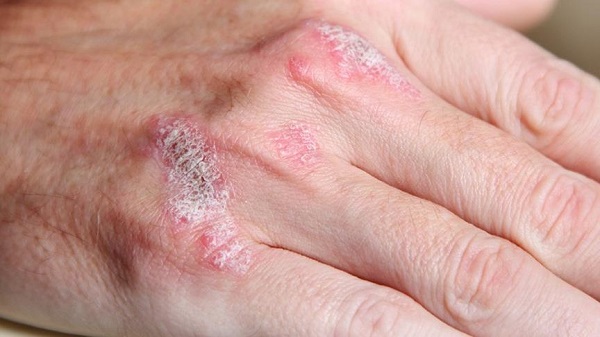 Yaz mevsiminde bu hastalık artış gösterdi