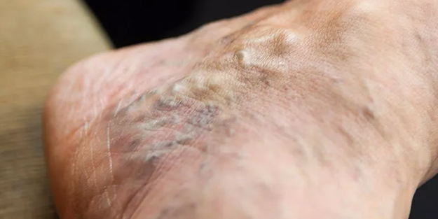 Yazın varis tedavisi olur mu?