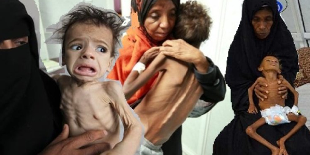 Yemen’de 6 milyon çocuk açlıktan ölmek üzere!