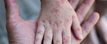 Yemen'de 7 ayda 15 çocuk kızamıktan öldü