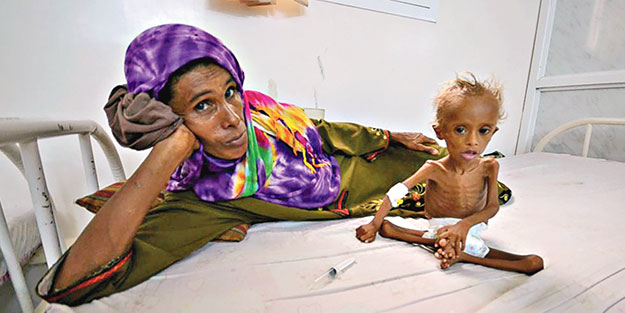Yemenli çocuklar bir deri bir kemik