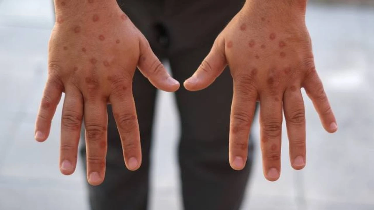 Yeni maymun çiçeği vakaları!