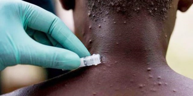 Yeni salgın kapıda mı? İşte 10 soruda maymun çiçeği hastalığı