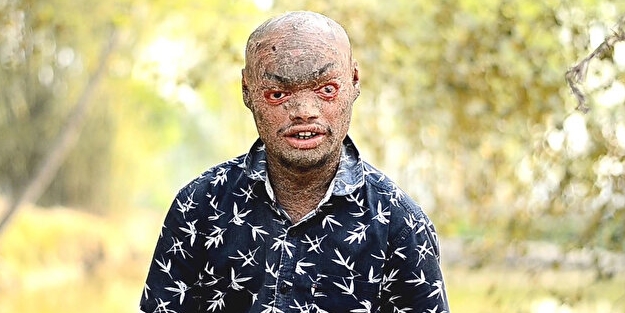 “yılan adam” Her hafta deri değiştiriyor