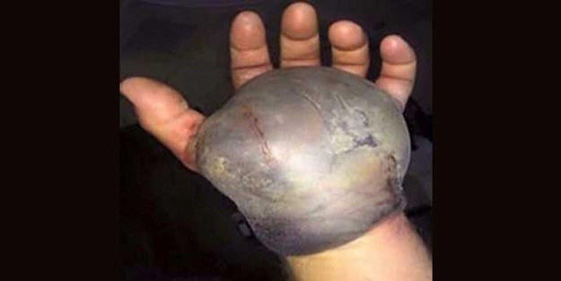 Yılan ısırdı, adamın eli bu hale geldi