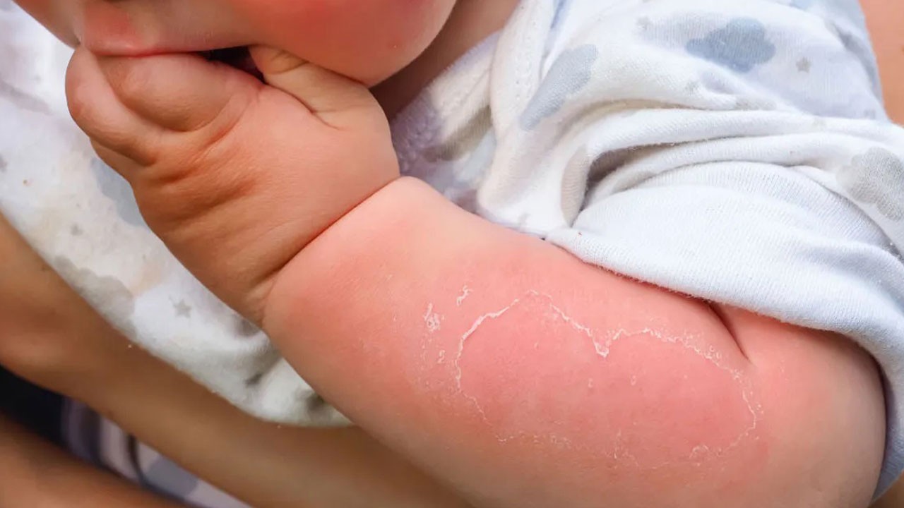 Yıllar sonra kanserle dönebilir! Bir tatil ömür boyu iz bırakabilir