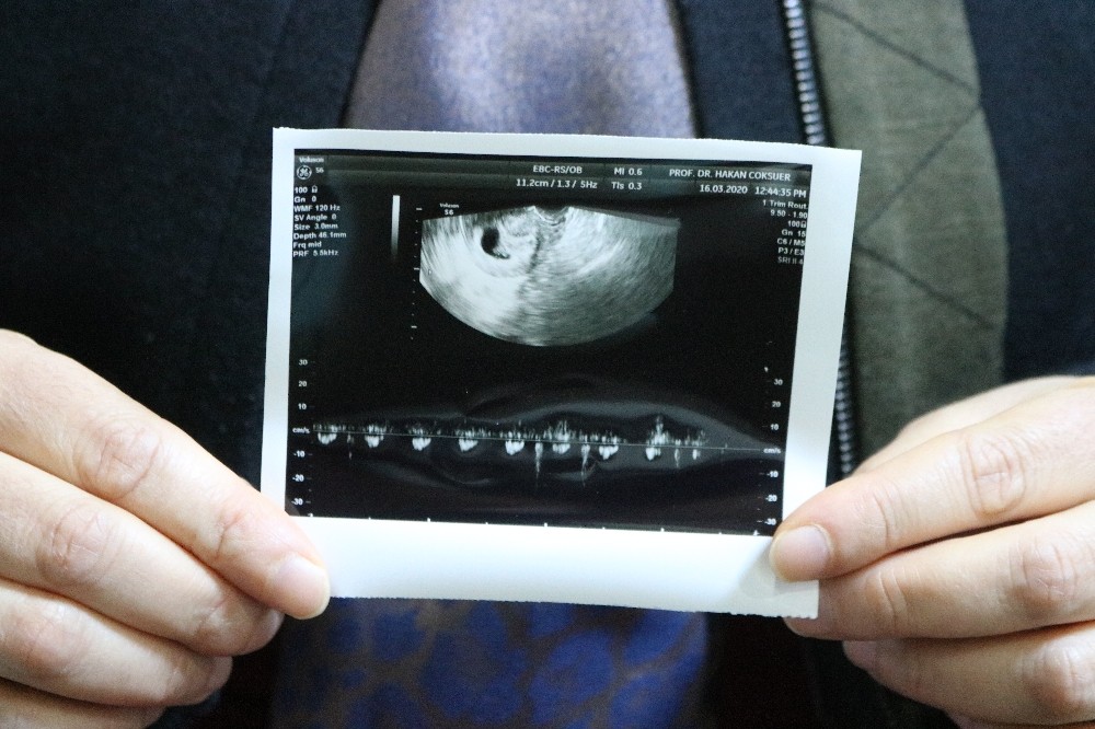 Yıllar süren çocuk hasreti akupunktur ve PRP tedavisiyle son buldu 