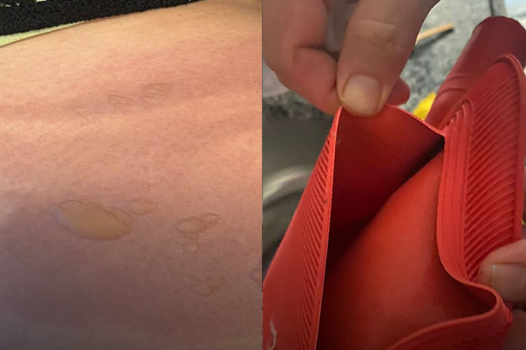 Yine sıcak su torbası vakası: Koyduktan 3 dakika sonra patladı!