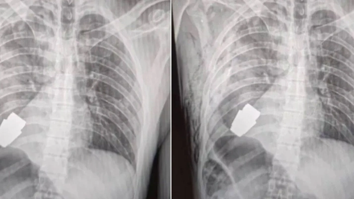 Yok artık daha neler! Vücudundan patlamamış el bombası çıktı