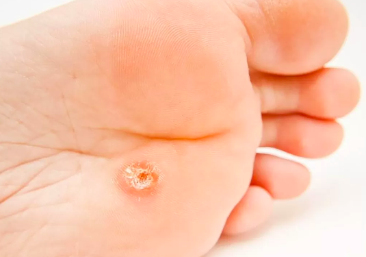 Yüksek topuklu ve dar ayakkabı nasır yapıyor!